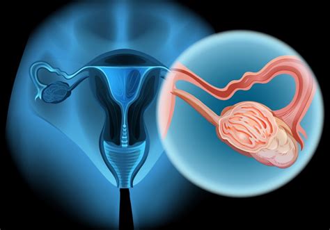 Cancerul Ovarian Cauze Factori De Risc I Op Iuni De Tratament