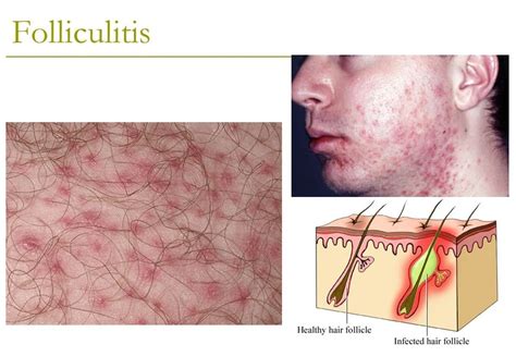 Folliculitis Causes Symptoms And Treatment