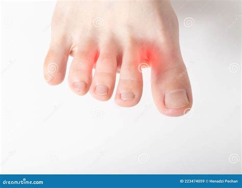 Dry Skin And Irritation Between The Toes White Background Fungus And