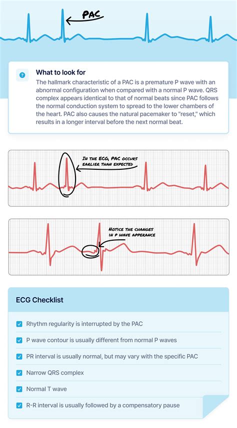 Premature Atrial Contractions Pacs Ecg Review Criteria And Examples