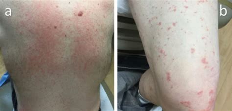 Refractory Dermatitis Contributed By Pityriasis Versicolor A Case