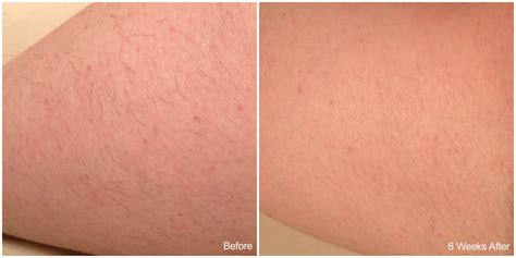 Laser Hair Removal Road Tested Part 1 Melbourne Mamma
