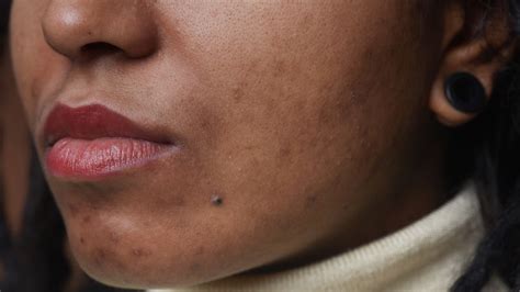 How To Treat Acne And Post Acne Marks On Dark Skin According To A