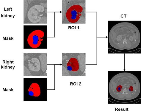 Frontiers Kidney Tumor Segmentation Based On Fr2pattu Net Model