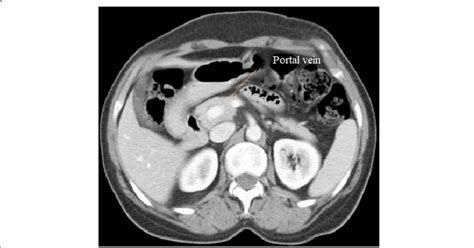 Circumportal Pancreas Portal Venous Phase Ct Axial Image Shows