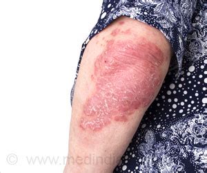 Tuberculosis is an often fatal but now extremely rare and treatable infectious disease. Skin Tuberculosis - Causes, Symptoms, Diagnosis, Treatment ...