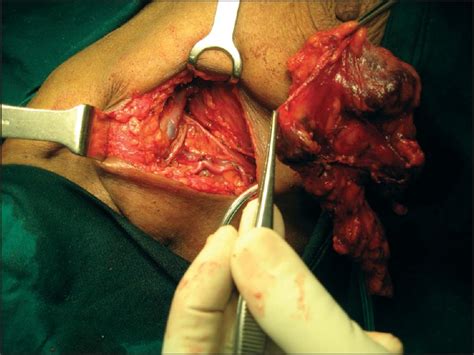 Axillary Lymph Node Metastasis In Papillary Thyroid Carcinoma Report