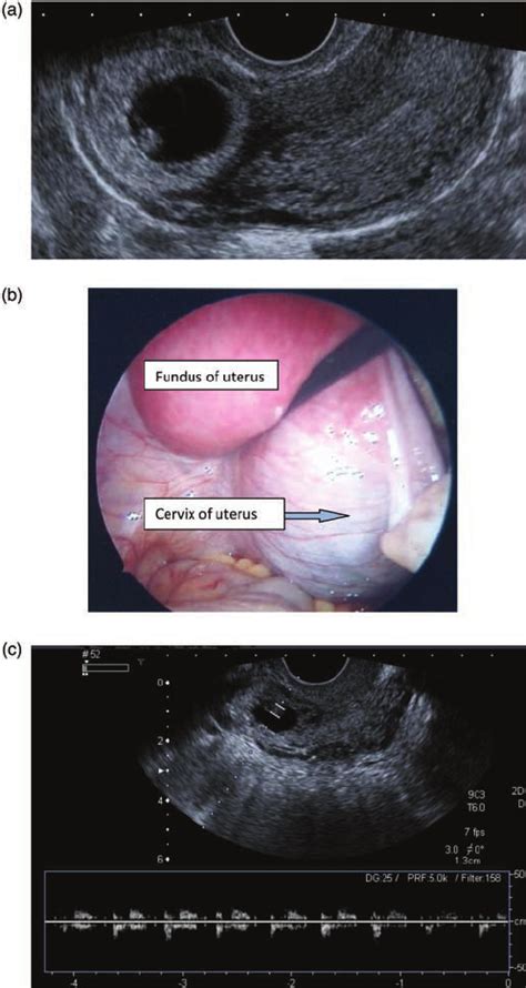 In its early stages, cervical cancer typically does not cause symptoms. (a) Cervical pregnancy, (b) laparoscopic view of cervical ...
