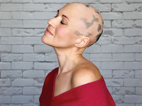Alopecia Universalis Woman