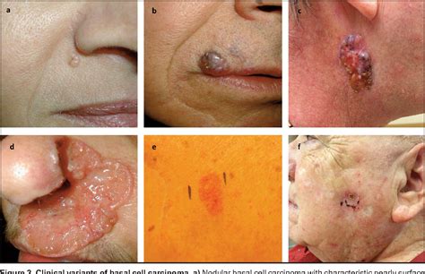 Basal Cell Carcinoma Pathogenesis Epidemiology Clinical Features My