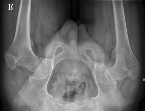 Anteroposterior Plain Radiograph Of The Left Hip Shows Posteroinferior