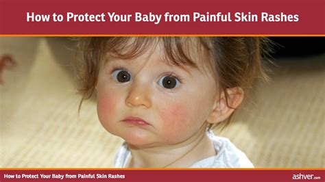How To Protect Your Baby From Painful Skin Rashes Youtube