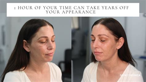 Skin Rejuvention Coolpeel Laser Day Before After Skin By