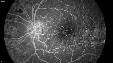 Fluorescein Angiography Ophthalmologists Island Retina