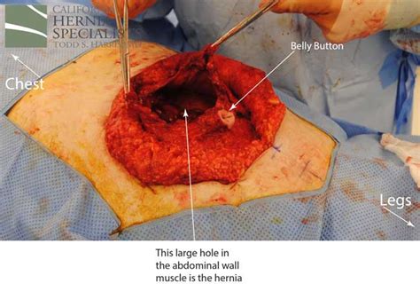 This new tissue will replace it and provide strength to the hernia repair. Hernia Types - Recurrent - California Hernia Specialists