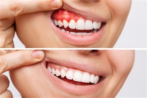 The Stages Of Gum Disease Explained By Seattle Dentists