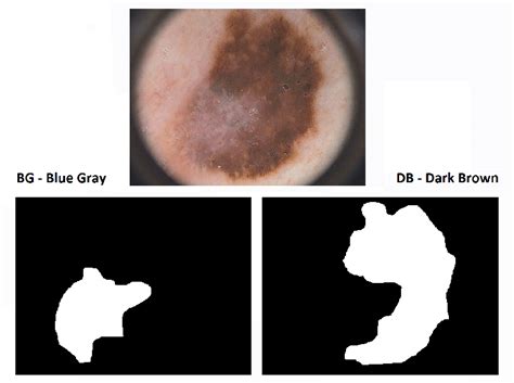 Example Of A Dermoscopic Image Imd19 And The Medical Evaluation