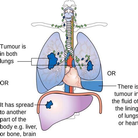 Effects Of Smoking On The Lungs