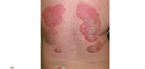 Psoriasis Well Demarcated Erythematous Scaly Plaques Relatively