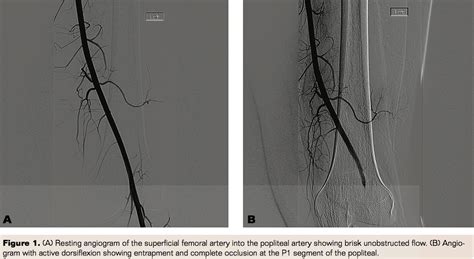 Popliteal Artery Entrapment Syndrome A Case Series With Variable