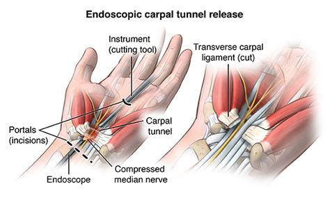 Carpal Tunnel Release Johns Hopkins Medicine