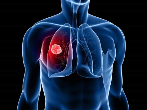 Find out more regarding lung cancer diagnosis methods and lung cancer stages. Lung Cancer - Causes, Diagnosis, Symptoms & Treatment
