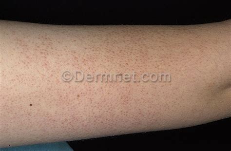 Keratosis Pilaris Pictures Dorothee Padraig South West Skin Health Care