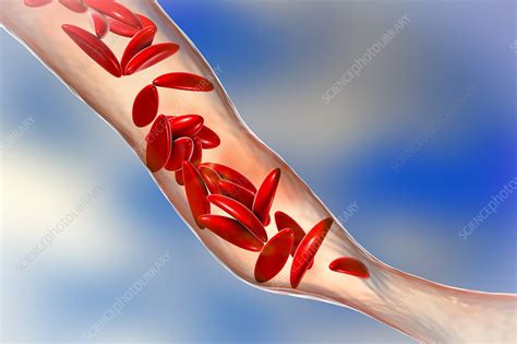 Blood Vessel Blocked In Sickle Cell Anaemia Illustration Stock Image