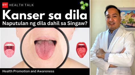 Kanser Sa Dila Tongue Cancer Naputulan Ng Dila Dahil Sa Singaw Youtube
