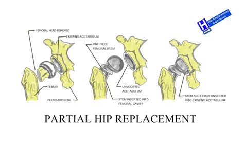 Hip Replacement Types Hip Replacement Experience Hip Replacement Hip Resurfacing Replacement