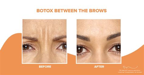 Using Botox For Wrinkles Between Eyebrows Tri Valley Livewell