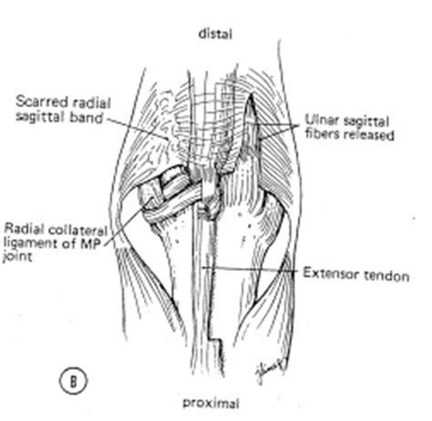 Sagittal Band Rupture Hand Orthobullets