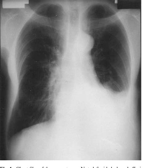 Figure 1 From Eosinophilic Pleural Effusion And Peripheral Eosinophilia