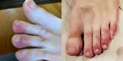 What Are Covid Toes Dermatologists Podiatrists Share Strange Findings