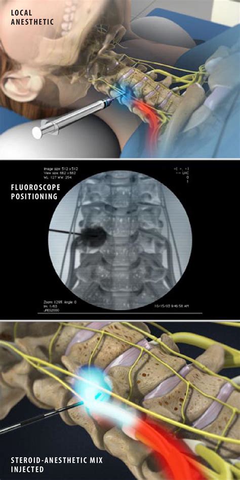 Cervical Epidural Steroid Injection Neck