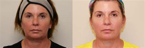 Ultherapy In Atlanta Ga Buckhead Facial Plastic Surgery