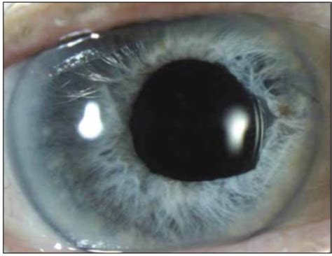 Crsteurope Complications Of Small Pupil Cataract Surgery