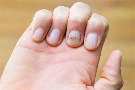 What happens if you don't take out a splinter? How Do I Get Yellow Stains Out of My Nails? | LIVESTRONG.COM