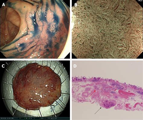 Importance Of Histological Evaluation In Endoscopic Resection Of Early