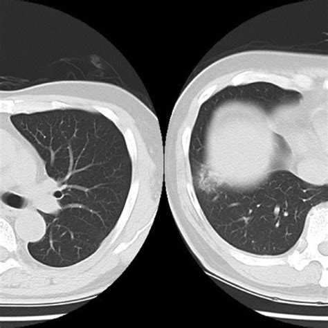 The Initial Chest Plain Computed Tomography Ct Scan Showed A Small