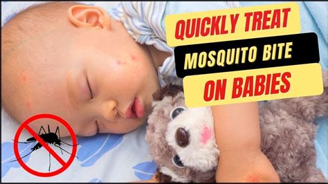 How To Treat Mosquito Bites On Babies Safe And Quick Home Remedies