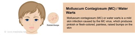 Molluscum Contagiosum Water Warts Causes Symptoms Diagnosis