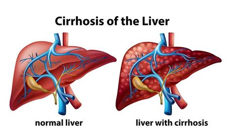 Cirrhosis And Its Complications Cirrhosis Pocketdrugguide