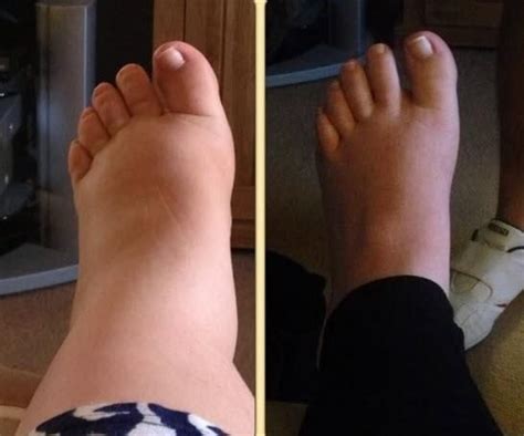 Compressa Swollen Feet Pregnancy Swollen Feet Swollen Feet Remedy