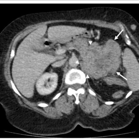 Contrast Enhanced Ct Scan Of The Abdomen Showing Large Ill Defined Soft