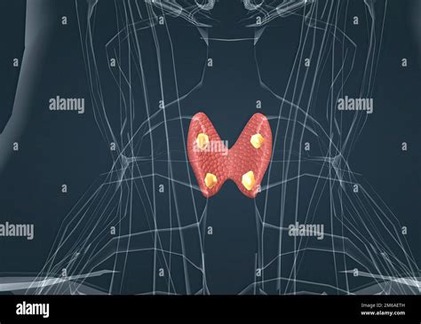 Multinodular Toxic Goiter Hi Res Stock Photography And Images Alamy