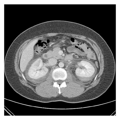 Contrast Enhanced Ct On The Day Of Admission Ct Revealed Nonspecific