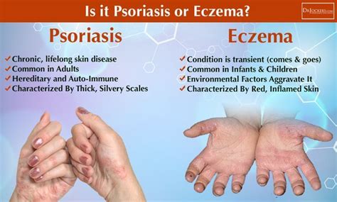 What Is The Difference Between Psoriasis And Eczema Psoriasishair