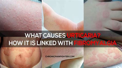 What Causes Urticaria How It Is Linked With Fibromyalgia Urticaria