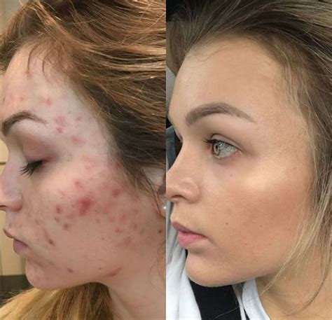 Houston Fitness Blogger Shares Before After Photos Of Her Remarkable Skincare Transformation
